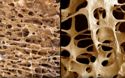 Osteoporosi: fenomeno in aumento tra gli ultraottantenni
