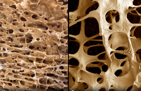 Osteoporosi: fenomeno in aumento tra gli ultraottantenni